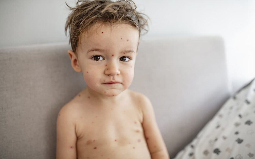 Childhealthy’s complete guide to chickenpox